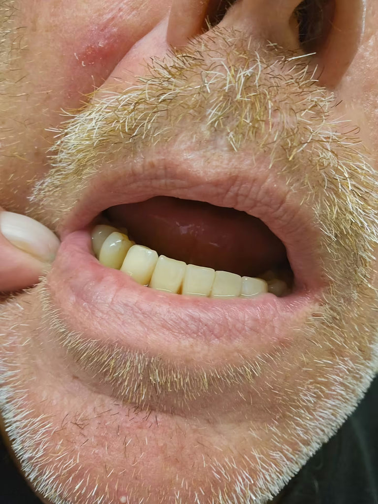 Today I&#8217;ll discuss if dentures can be made at home.