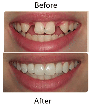 What Happens if You Don’t Replace a Missing Tooth