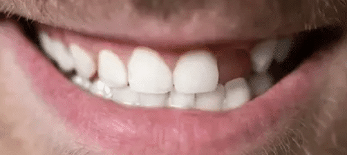 Today We Discuss The Importance of Addressing a Single Missing Tooth with Partial Dentures
