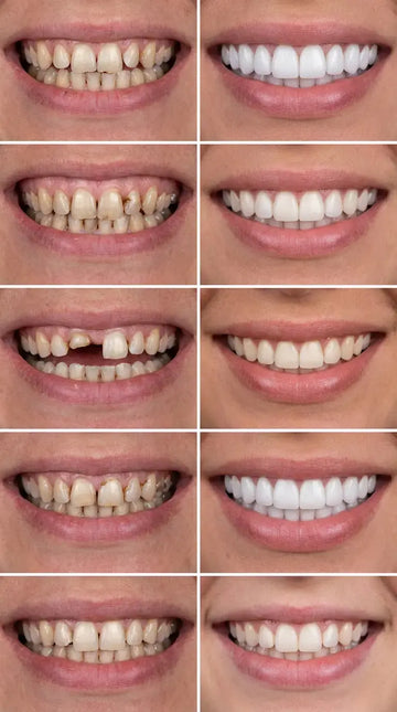 Veneers | Dentist Directed Veneers – Denture Rescue