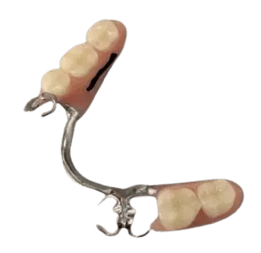 metal partial denture