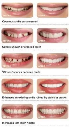 Snap On Smile - Veneers - Pop & Fit Dentist Directed  - Impression Kit Included Denture Rescue