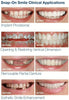 Snap On Smile - Veneers - Pop & Fit Dentist Directed  - Impression Kit Included Denture Rescue