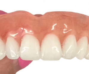 Why are regular dentures better than 3D printed dentures?