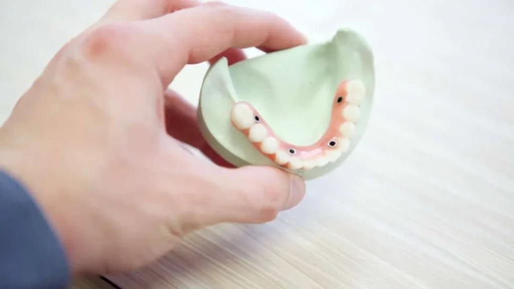 dentures supported by implants