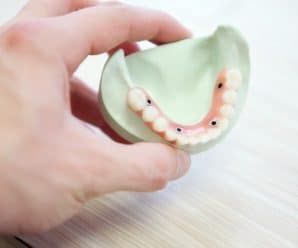 13 Reasons to Consider Getting Dentures Supported by Implants