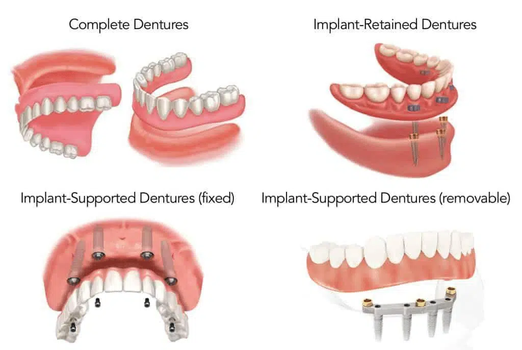 snap in dentures