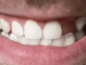 Today We Discuss The Importance of Addressing a Single Missing Tooth with Partial Dentures