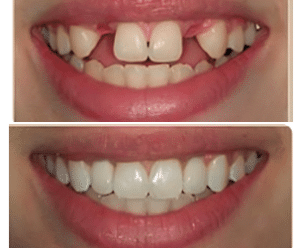 What Happens if You Don’t Replace a Missing Tooth
