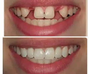 What Happens if You Don’t Replace a Missing Tooth