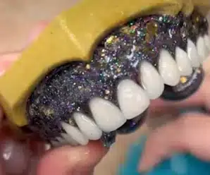 Today We Discuss Glitter Dentures Sparkle and Shine: Exploring for a Dazzling Smile