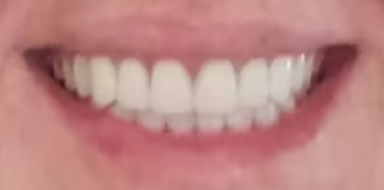boil and bite dentures in mouth
